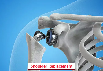 Shoulder Replacement