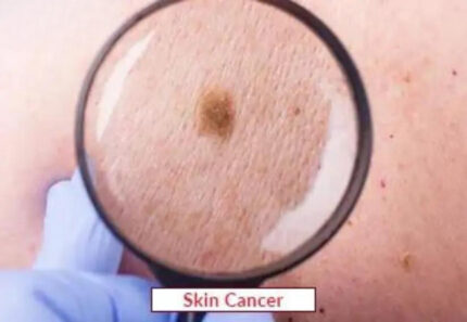 Skin Cancer