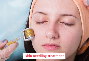 Skin Needling Treatment