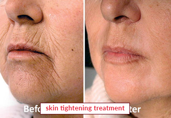 Skin Tightening Treatment