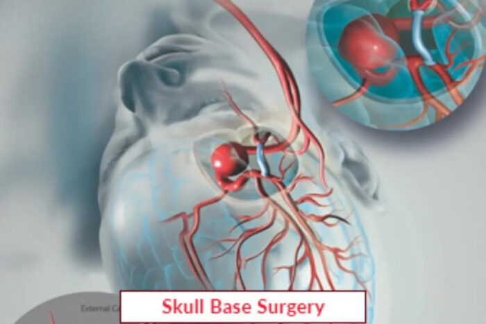 Skull Base Surgery