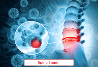 Spine Tumor Surgery