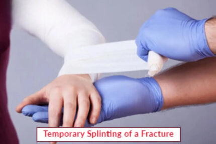 Splinting Fracture