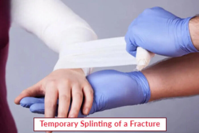 Splinting Fracture