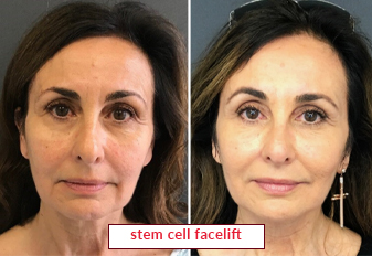 Stem Cell Facelift