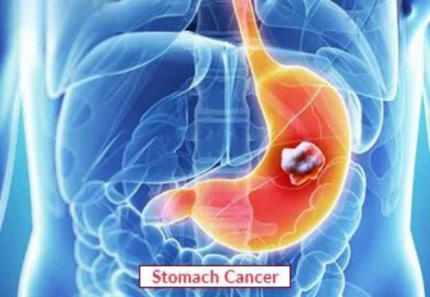 Stomach Cancer Treatment