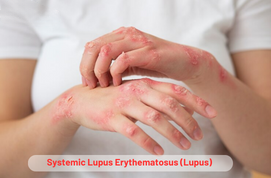 Systemic Lupus Erythematosus