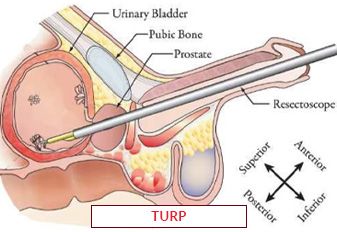 TURP