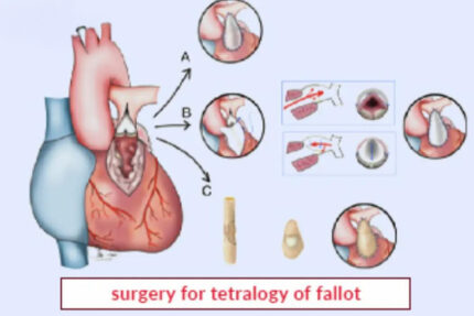 Tetralogy Of Fallot