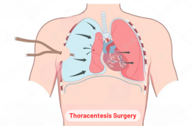 Thoracentesis Surgery