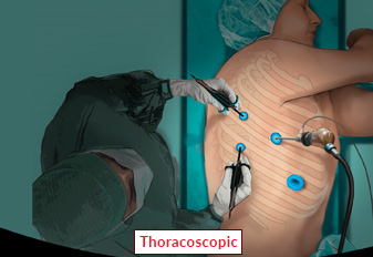 Thoracic Surgery