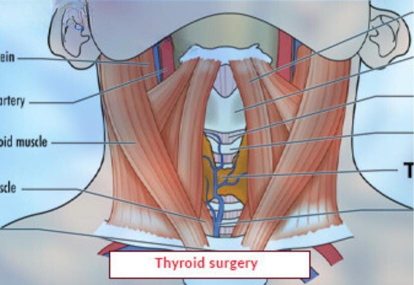 Thyroid Surgery Treatment