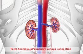 Total Anomalous Pulmonary Venous Connection