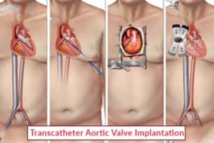 Transcatheter Aortic Valve Implantation