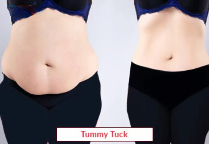 Tummy Tuck Surgery