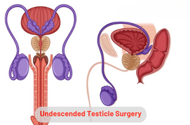 Undescended Testicle Surgery