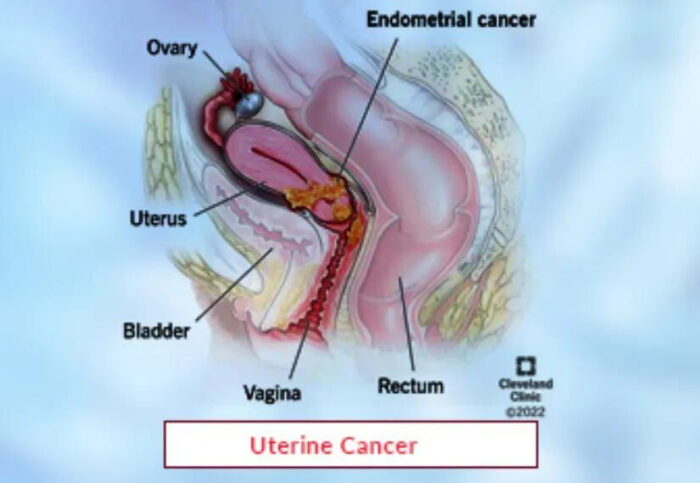 Uterine Cancer