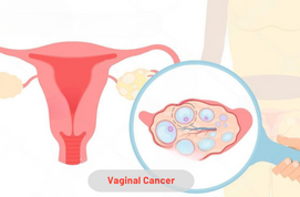 Vaginal Cancer