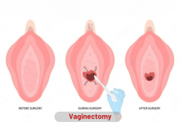 Vaginectomy