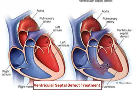 Ventricular Septal Defect (VSD)