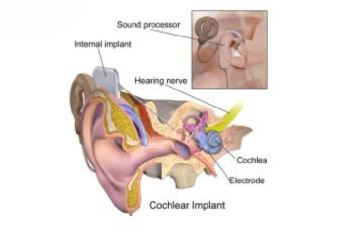 Vertigo Surgery