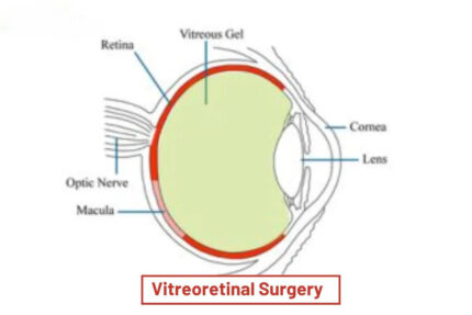 Vitreoretinal Surgery