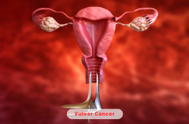 Vulvar Cancer