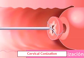 cervical-conization