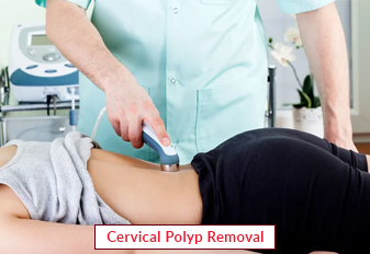 cervical-polyp-removal