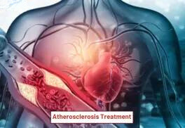 Atherosclerosis Treatment