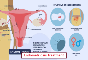 endometriosis-treatment