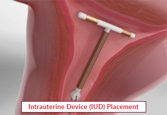 intrauterine-device-placement