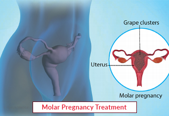 molar-pregnancy-treatment