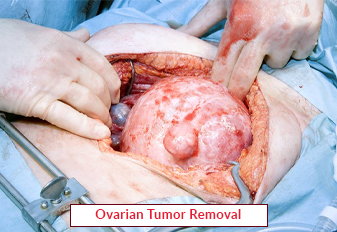 Ovarian Tumor Removal