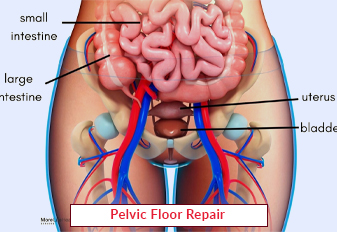 Pelvic Floor Repair