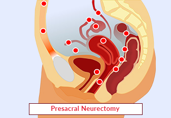 Presacral Neurectomy