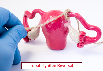 Tubal Ligation Reversal