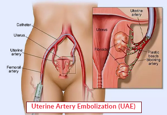 Uterine Artery Embolization (UAE)