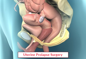 Uterine Prolapse Surgery