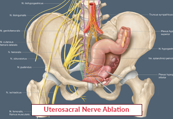 Uterosacral Nerve Ablation