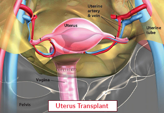 Uterus Transplant