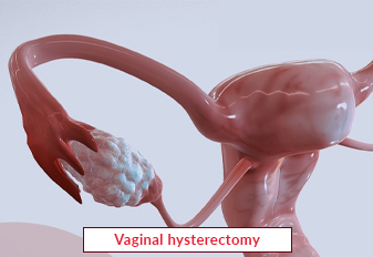 Vaginal Hysterectomy