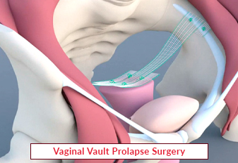 Vaginal Vault Prolapse Surgery