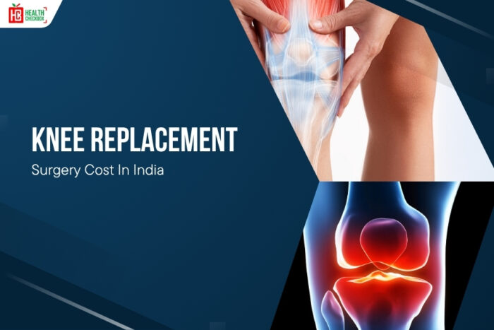 Knee Replacement Surgery Cost In India: Detailed Price Guide