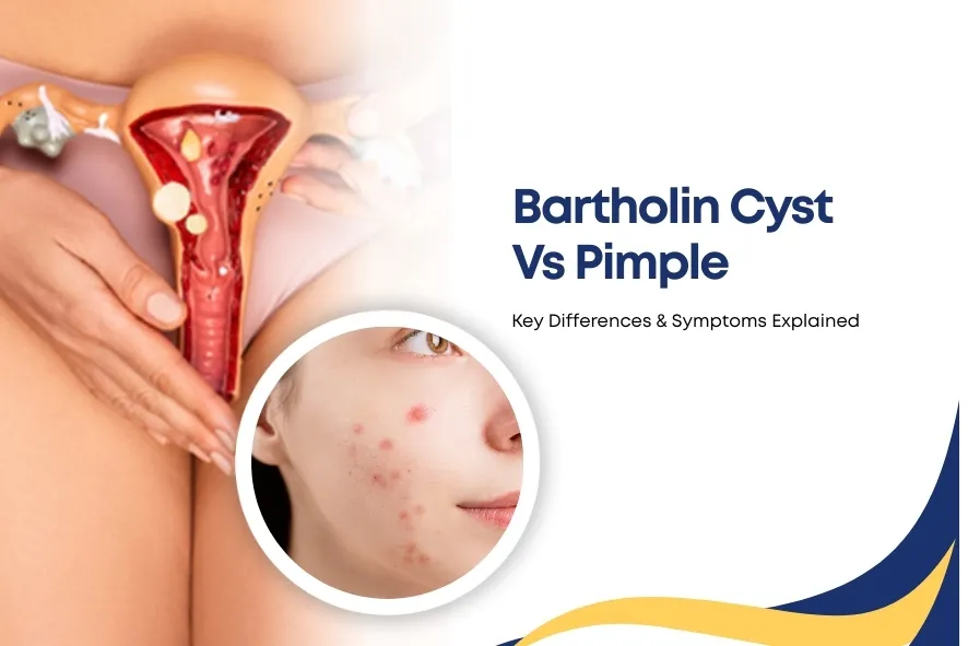 Bartholin Cyst Vs Pimple-blog img